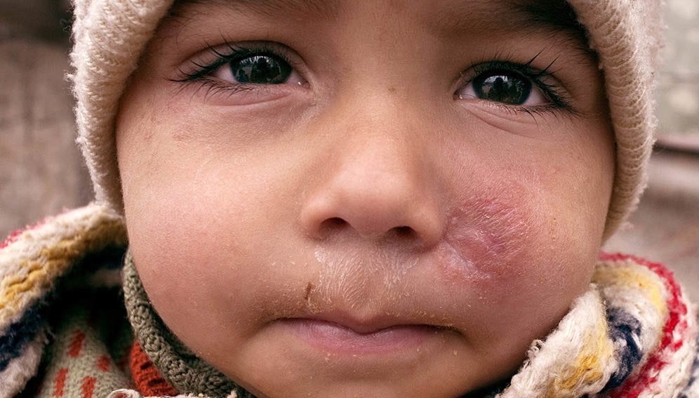 Leishmaniasis in Syria - Main