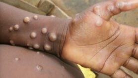 Why Nigeria may be missing silent mpox transmission