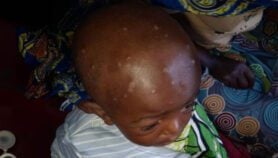 Mpox: still no jabs for ‘most at risk’ children in DRC