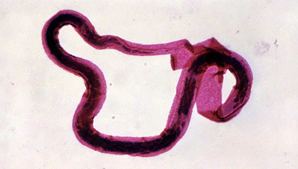 A filarial worm, one of the causative agents of Elephantiasis (lymphatic filariasis)