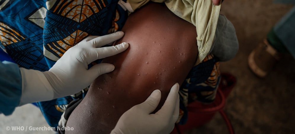 A health worker examines skin lesions that are characteristic of mpox on the back of a young child at the mpox treatment centre at the Nyiragongo General Referral Hospital, north of Goma in the Democratic Republic of the Congo (DRC) on 14 August 2024. Credit: Guerchom Ndebo / WHO